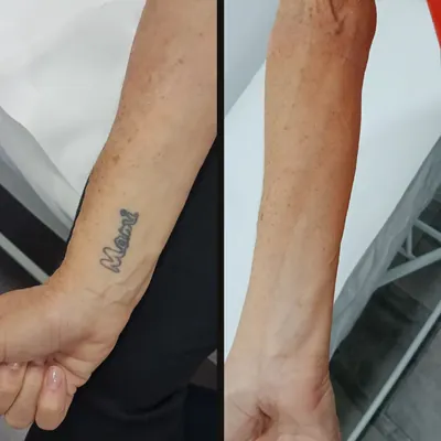 Antes y después: nombre en el antebrazo