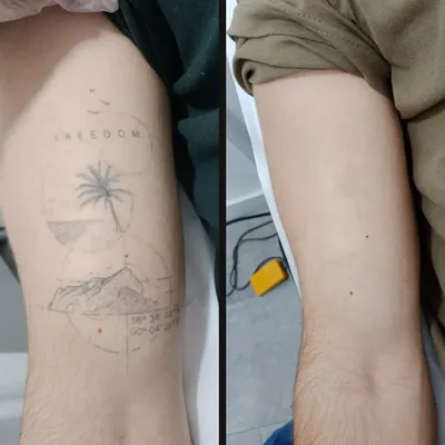 Antes y después: «Freedom» fine line en el brazo