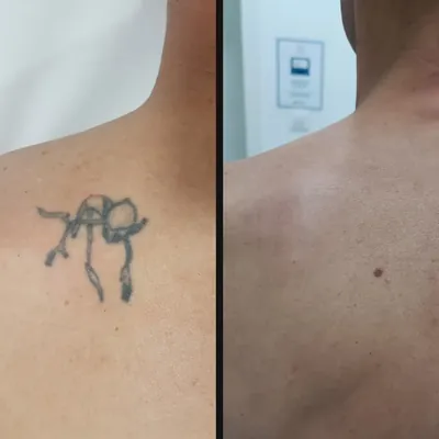 Antes y después: lazo en el omóplato