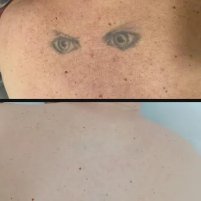 Antes y después: ojos en la espalda