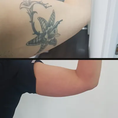 Antes y después: flor en la cara interna del brazo