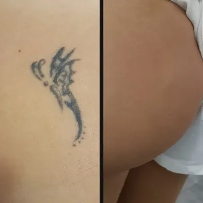 Antes y después: mariposa tribal en el glúteo